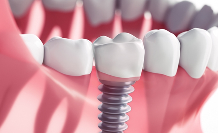 Dental Implant