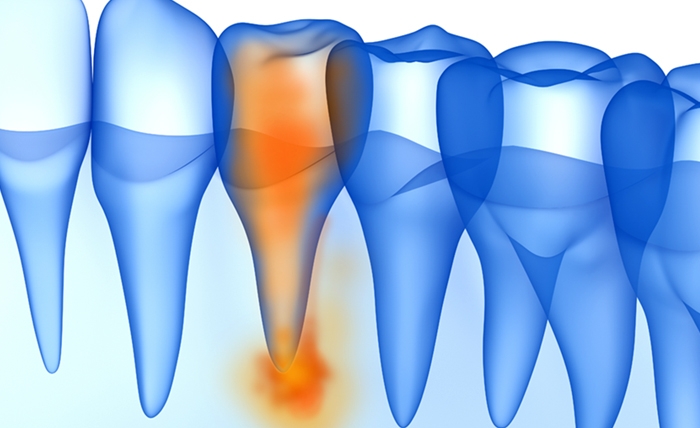 Root Canal Therapy