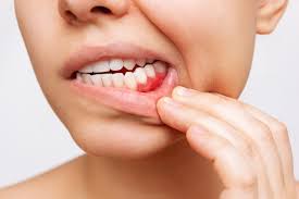 How to Stop Gum Bleeding Immediately: A Comprehensive Guide