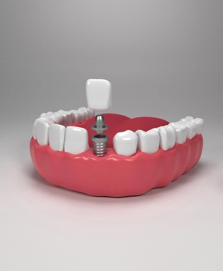 Dental Implants 6
