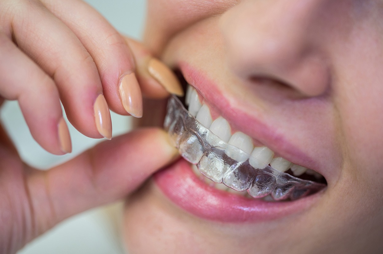 woman-wearing-orthodontic-silicone-invisible-braces.jpg